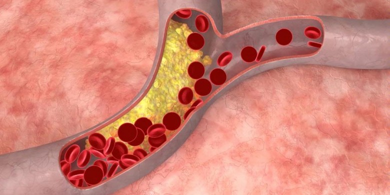 kan damarlarındaki plaklar