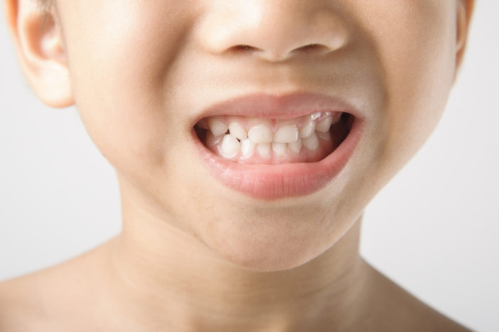 çocuk dişlerinde lekeler