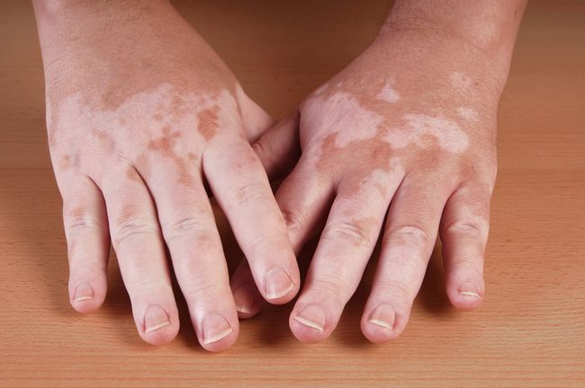vitiligo iyileşebilir
