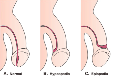 penis deliği normal değildir, hipospadias dönemi