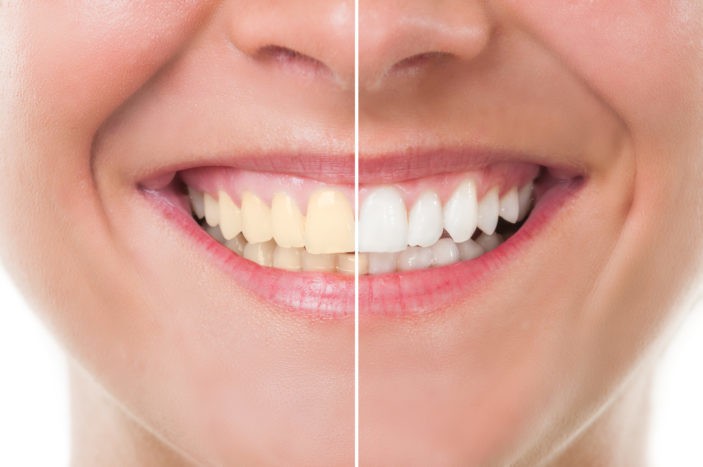 Beyazlatıcı dişlerin ağartma ile yan etkileri