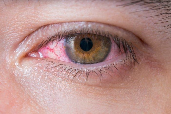 alerjik kırmızı göz konjonktiviti