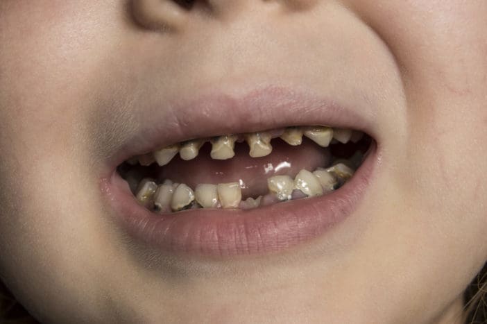 Çocuk diş çürüğü için biberon diş çürüğü
