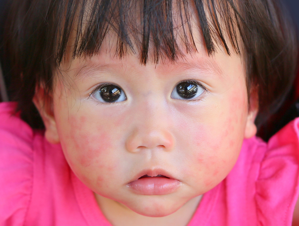 İnek sütüne alerjisi olan bebeklerin özellikleri
