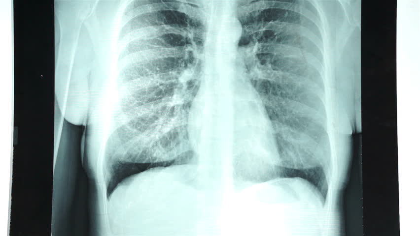 göğüs röntgeni