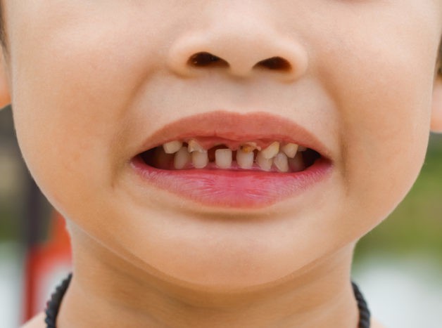 çocuk dişlerinde hasar