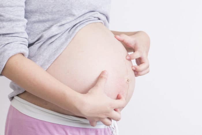 hamilelik sırasında prurigo