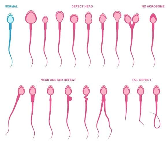 sperm anomalileri